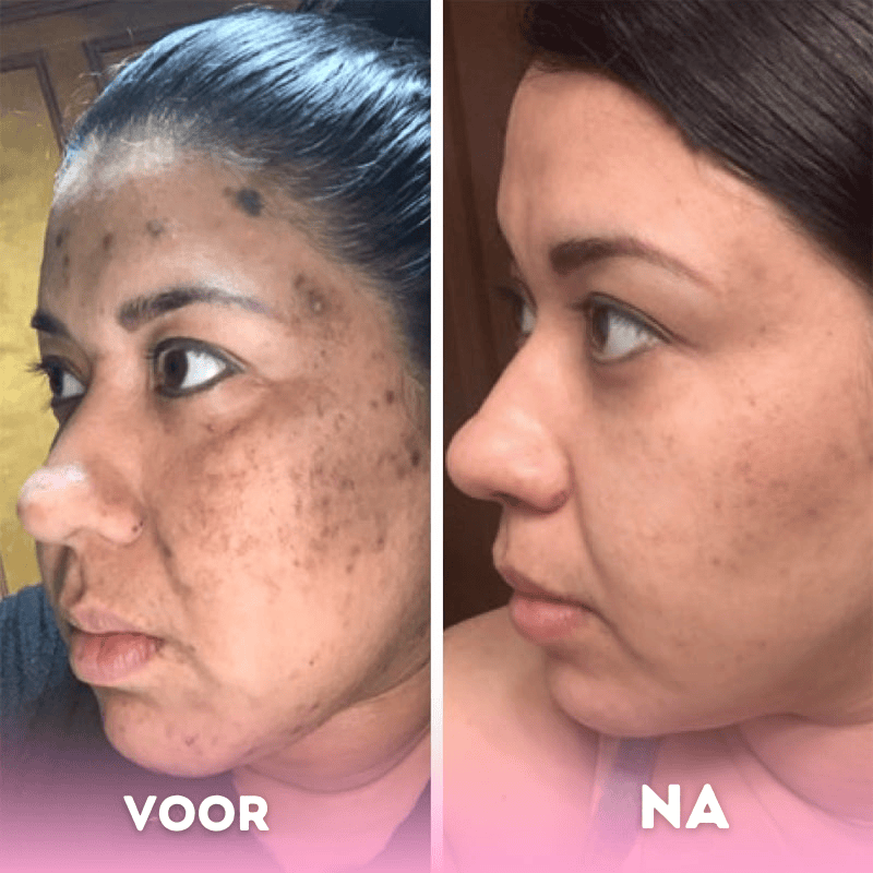 Turmeric Kojic Acid Pads